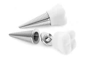 Dental implant orlando florida